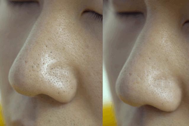 有黑头和没黑头有什么区别,没有长过黑头却长黑头怎么办