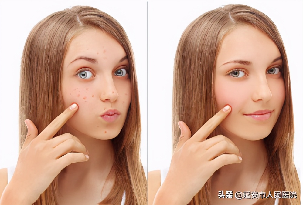 痒到怀疑人生的湿疹,到底该怎么办?