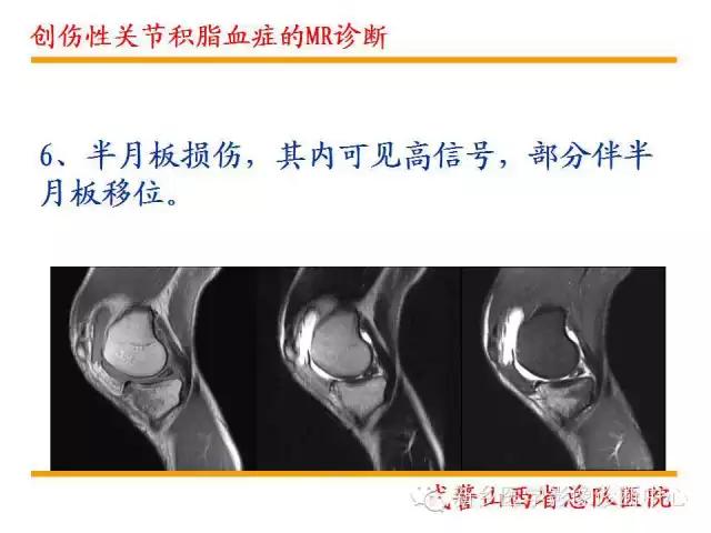 膝关节炎髌上囊积液自己看得出吗,髌上囊有积液膝盖会走路无力吗