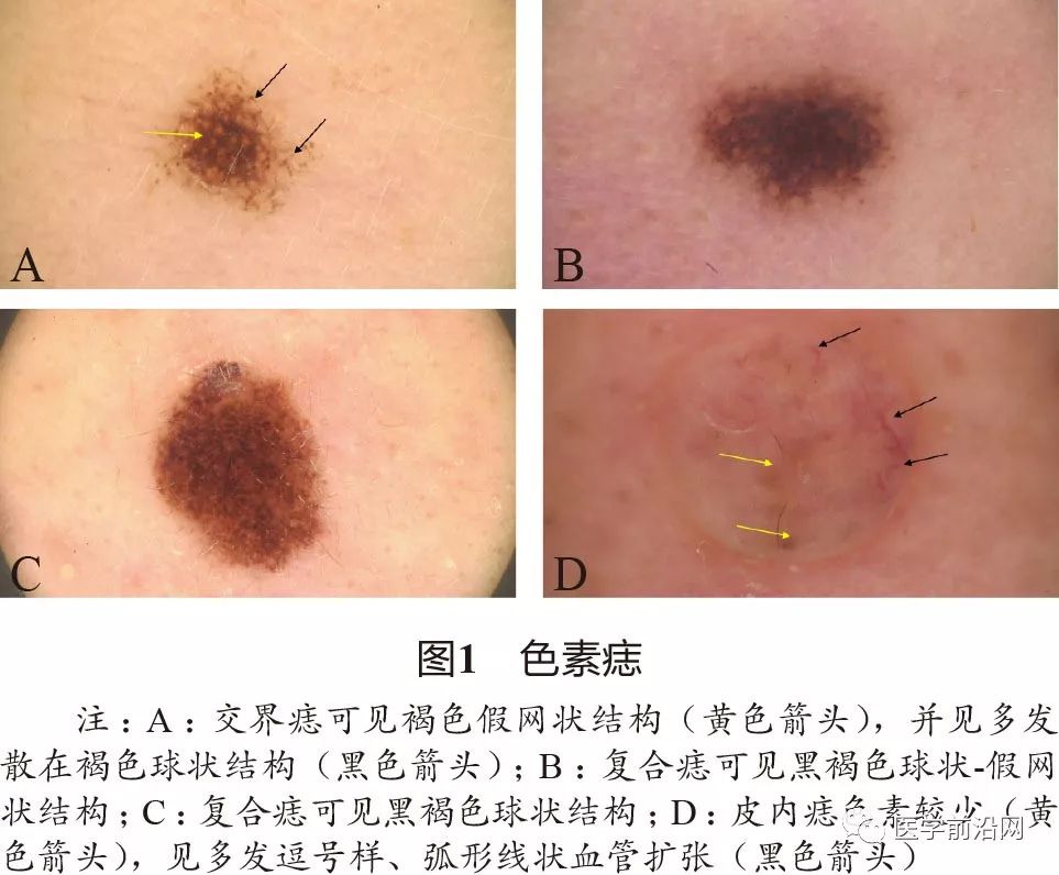 面部常见皮肤病皮肤镜诊断专家共识全文发布