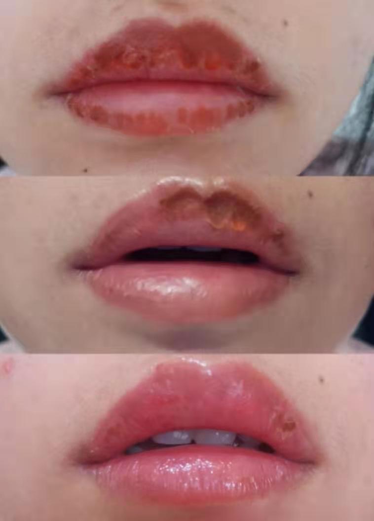 改善干燥起皮护唇液,三个护唇小妙招应对嘴唇干裂起皮