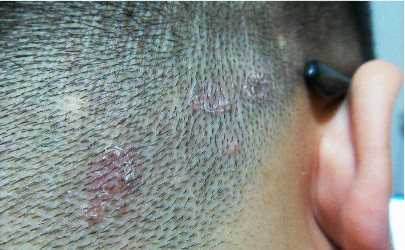 米诺地尔有什么副作用吗,米诺地尔副作用和禁忌