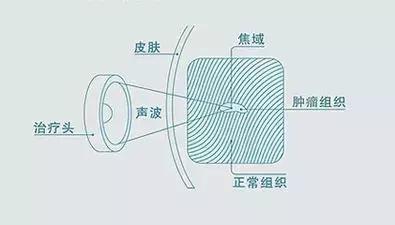 超声胃镜后的饮食注意事项,超声聚焦治疗后注意什么
