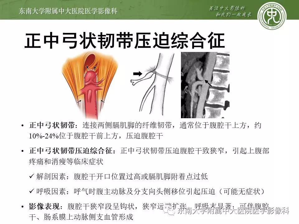 肠系膜上动脉压迫综合征挂什么科,肠系膜上动脉压迫综合征手术费用