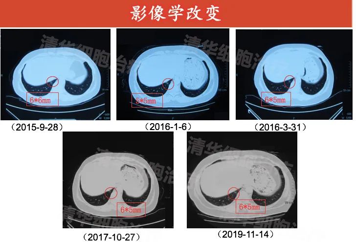 nkt治疗肝癌成功案例,nkt治疗乳腺癌