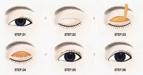 想做双眼皮是不是得检查下视力,想做双眼皮攻略