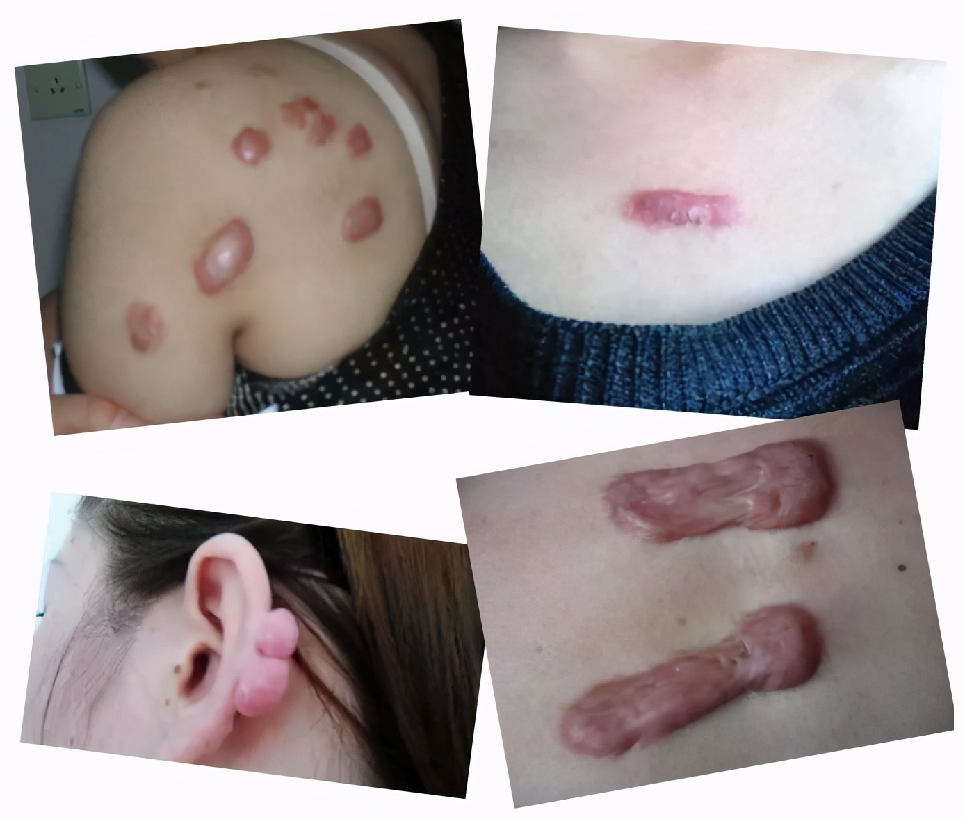 身上起疤痕状疙瘩,身上有疤痕啥的一直不消怎么回事