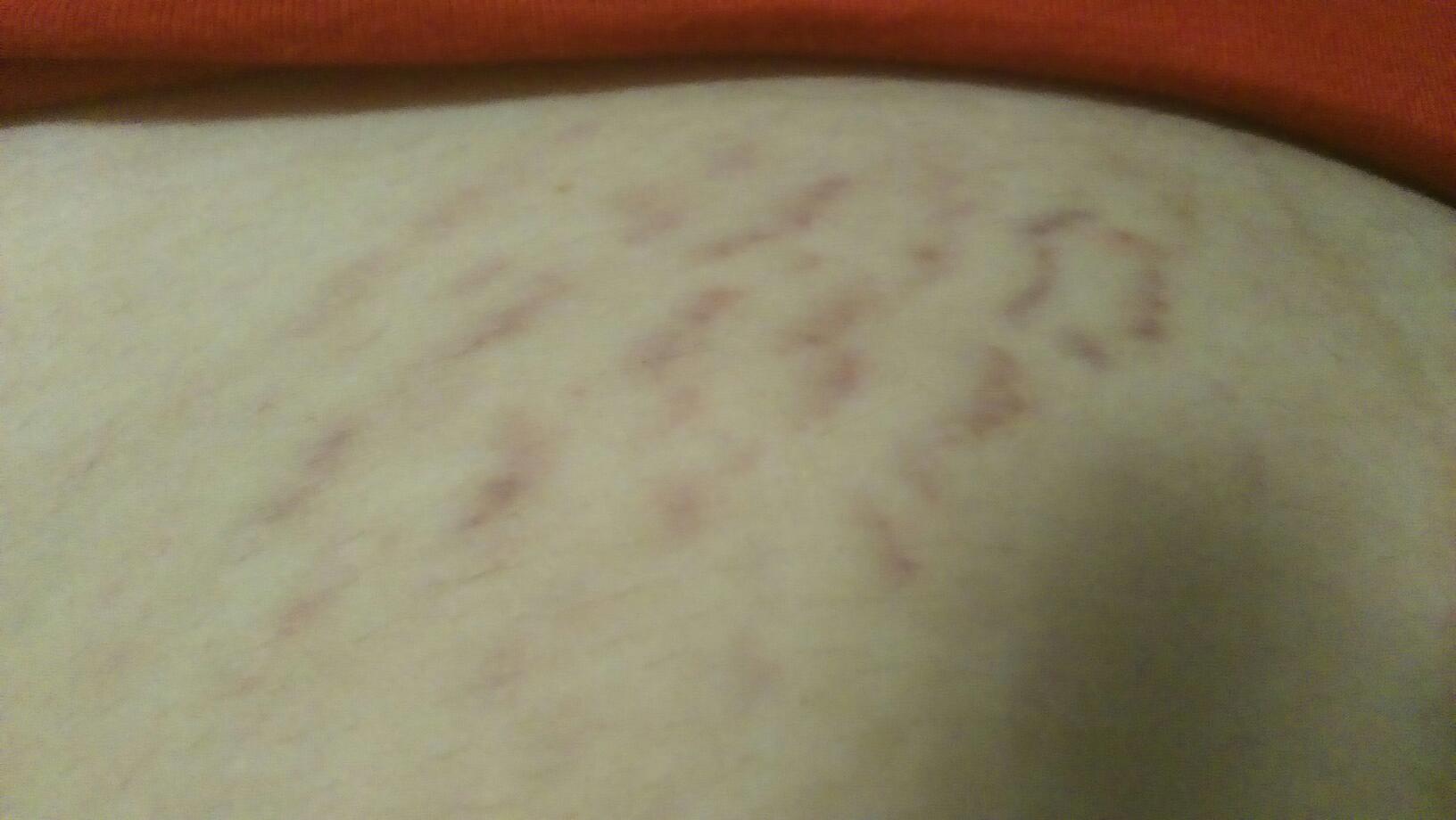 阿根廷出血热症状表现,阿根廷出血热临床表现