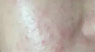 熬夜追《知否》后脸上狂暴痘？这些德国产品可以拯救你的脸！