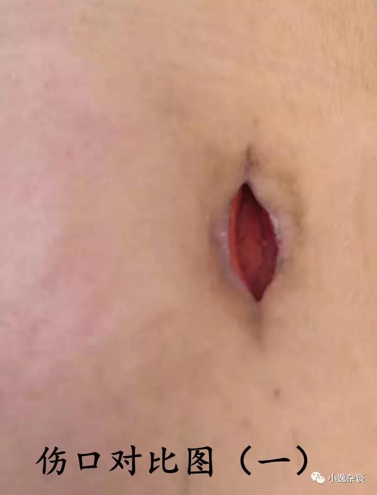 皮肌炎回忆录（十）