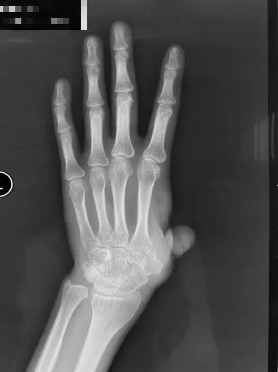 北京积水潭医院3d打印技术,北京积水潭医院3d手指再造价格