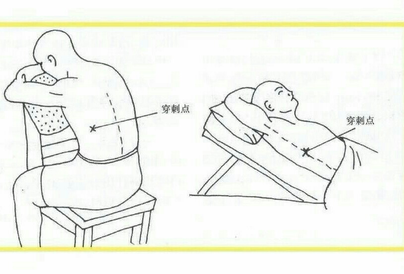 癌症病人胸腔积液后期会怎么排出,癌症病人出现胸腔积液怎么办