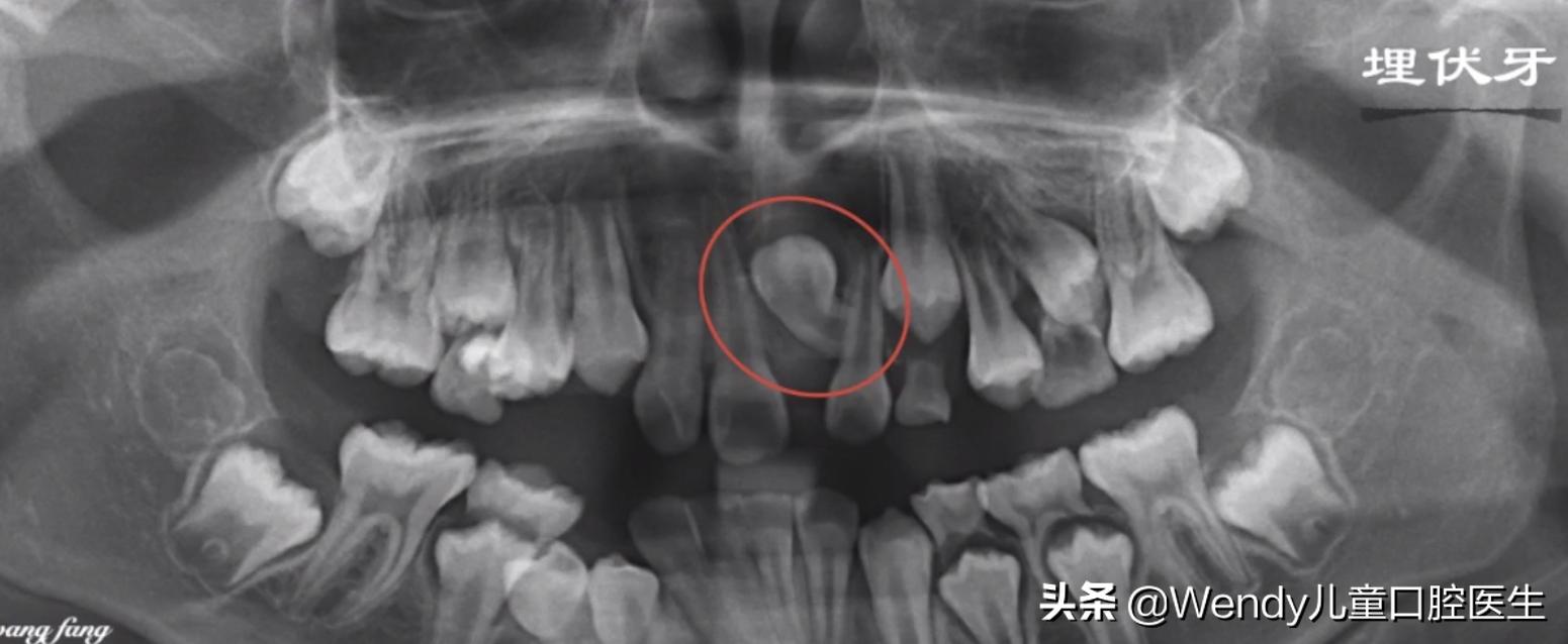 小孩乳牙掉了一直不长是什么原因,小孩乳牙掉了迟迟不出啥原因