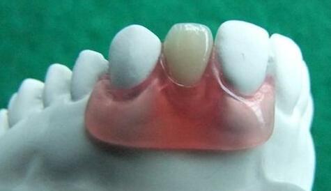 做一颗临时牙教程,自制隐形牙