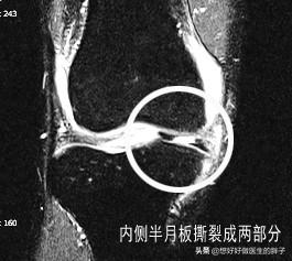 膝关节核磁共振报告单上怎么看,膝关节核磁正常报告单