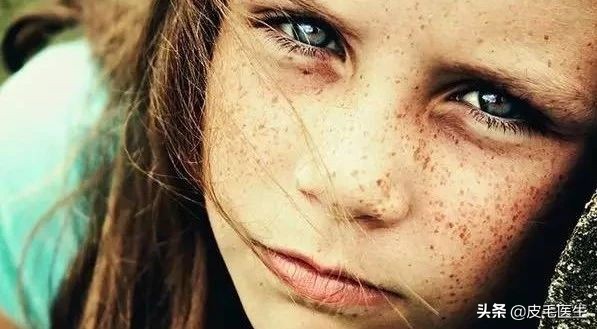 褐斑祛斑最有效方法,年轻人脸上长褐斑老年斑如何治疗