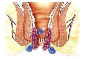 直肠指检百科,直肠指诊科普系列三