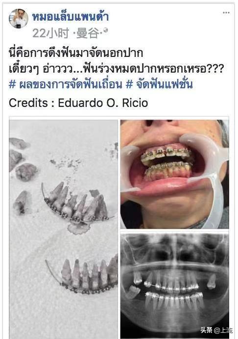 泰国流行戴牙套,泰国最近很火的牙套