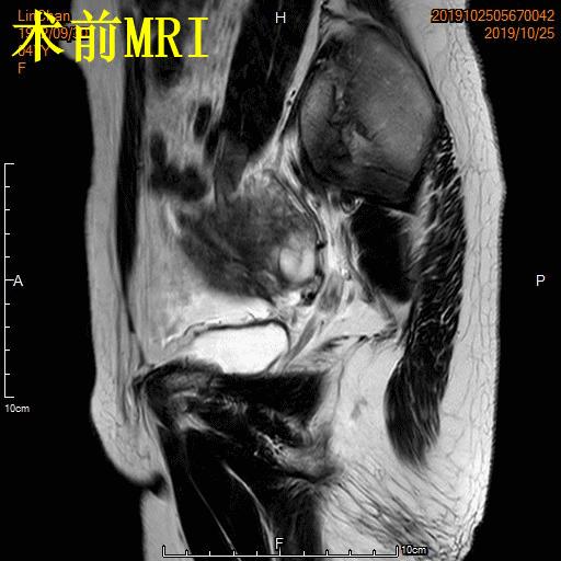 子宫腺肌症介入栓塞全国哪里好,子宫腺肌症介入栓塞治疗报销吗