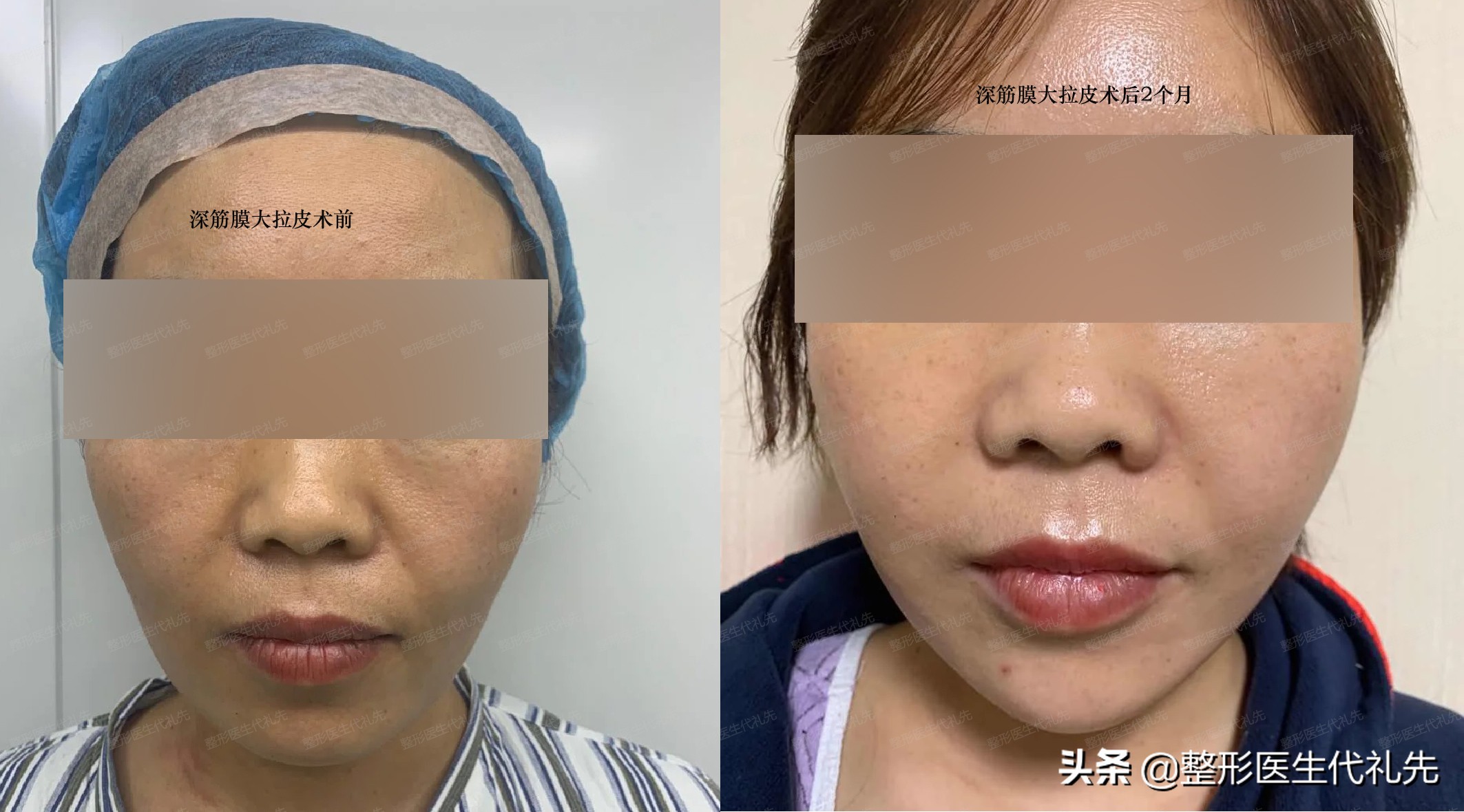 拉皮手术能改善法令纹眼角纹吗,大拉皮手术专门去法令纹怎么做