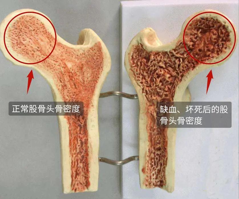 股骨头坏死和腰间盘突出症状区别,椎间盘突出和股骨头坏死症状区别