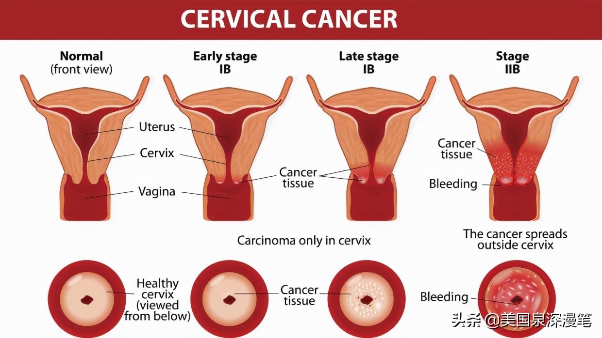 英国hpv,英国hpv疫苗九价价格