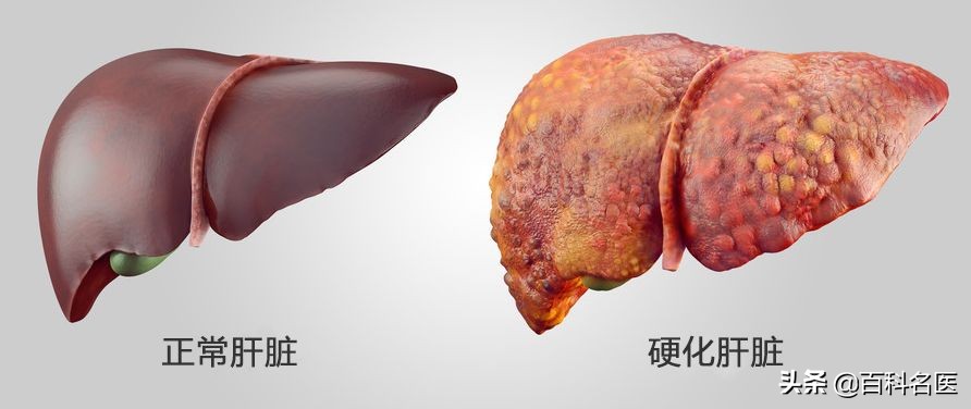 脂肪性肝炎需要注意什么,世界肝炎日肝炎你了解吗