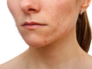 痘痘肌生活中有哪些需要注意的,痘痘肌护肤注意事项图片卡通