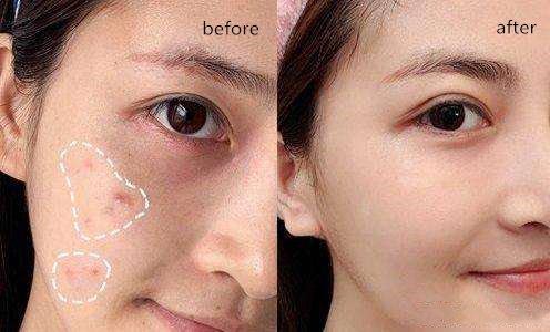 白天身上螨虫多是什么症状,身上螨虫多影响护肤吗