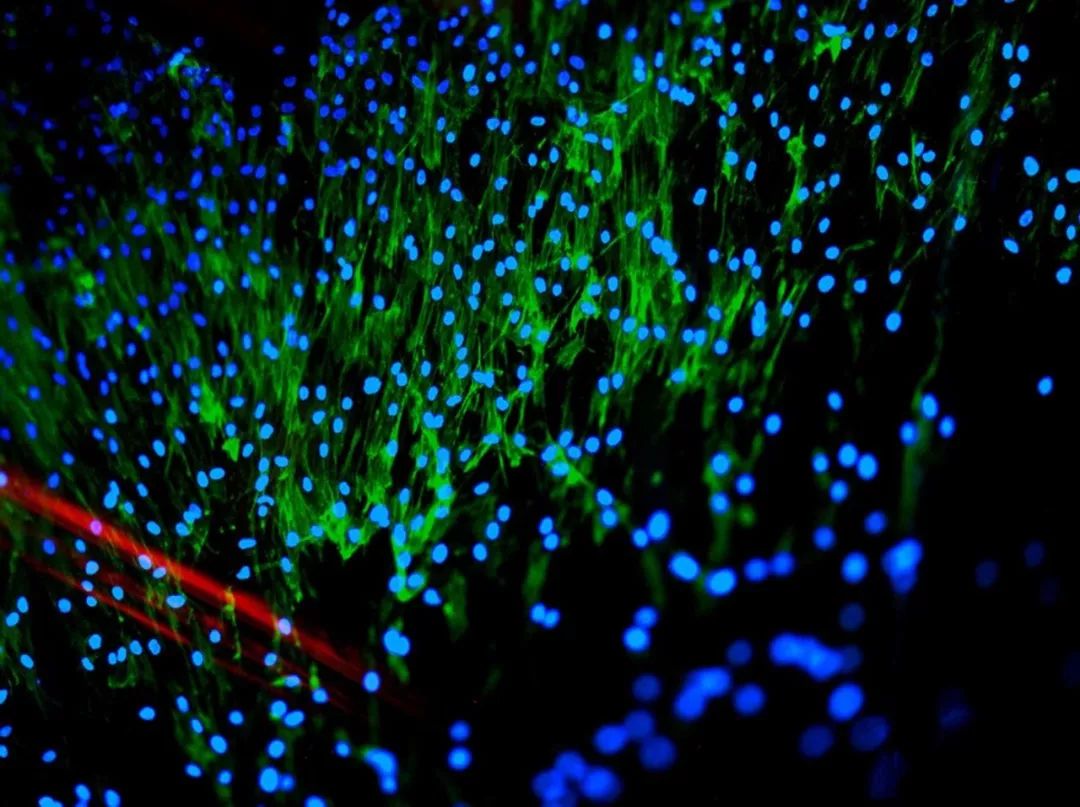 干细胞治疗类风湿关节炎,类风湿性关节炎输液有用吗