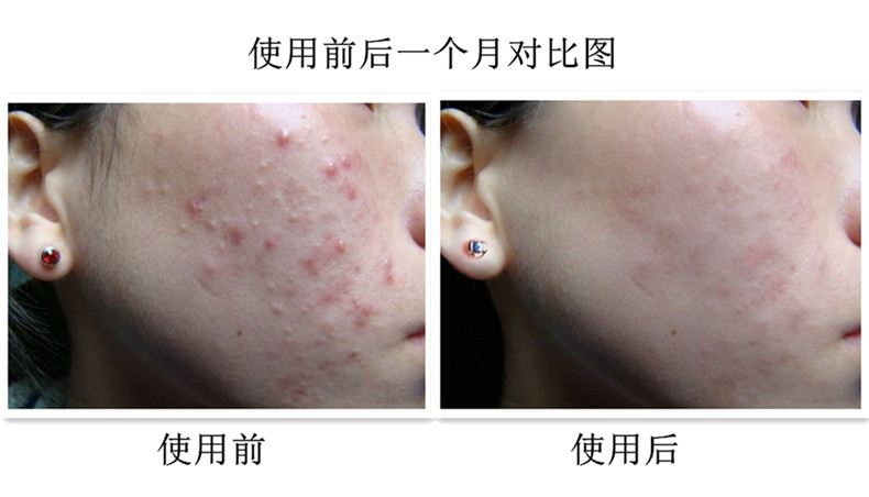 清痘润颜修复凝胶效果怎么样,xdg清颜修护凝胶