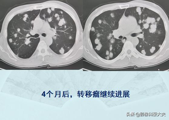 癌症晚期肺转移还能活多久,肺癌症晚期能有必要化疗吗