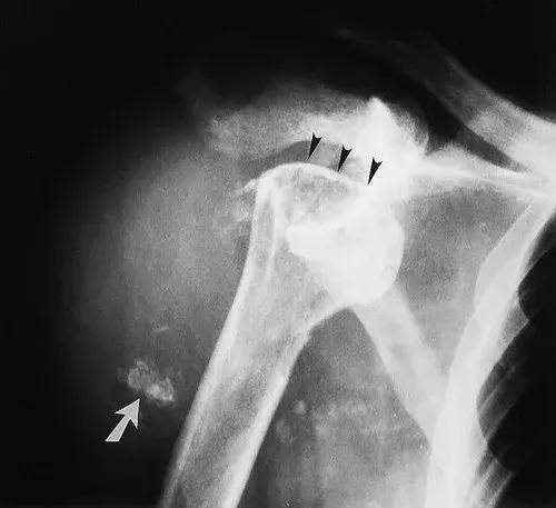 神经性骨关节病,神经性关节炎症状图片