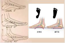 鹅趾肌腱滑囊炎还能跑步吗,跑步滑囊炎一般要休息多久