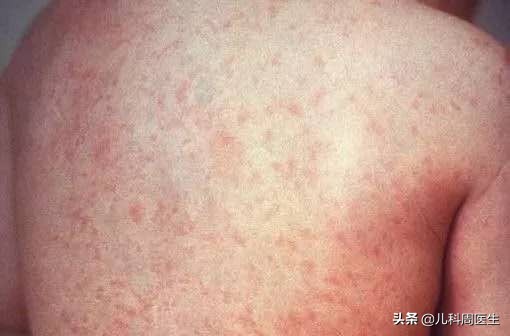 孩子热疹有什么好办法,反复发热有没有可能是幼儿急疹