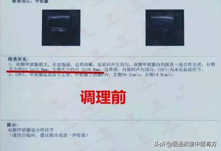 31mm实性结节怎样处理,11毫米的混合性结节需要手术吗