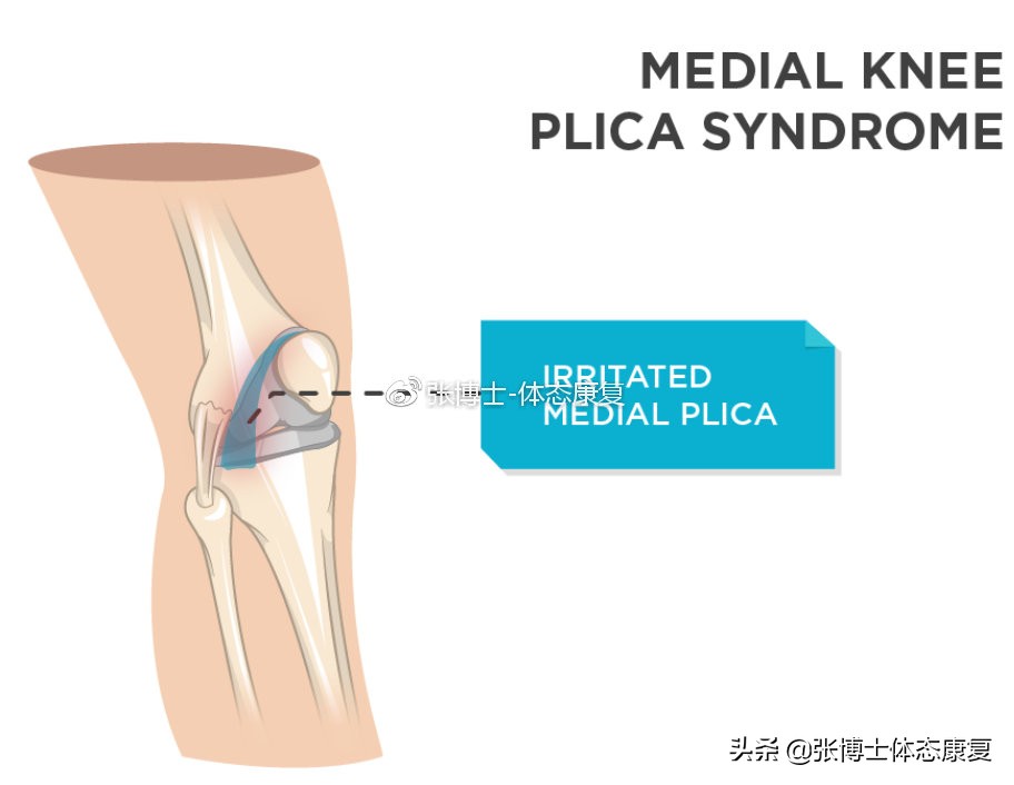 【运动康复科普】为什么你的膝关节内侧会出现疼痛？