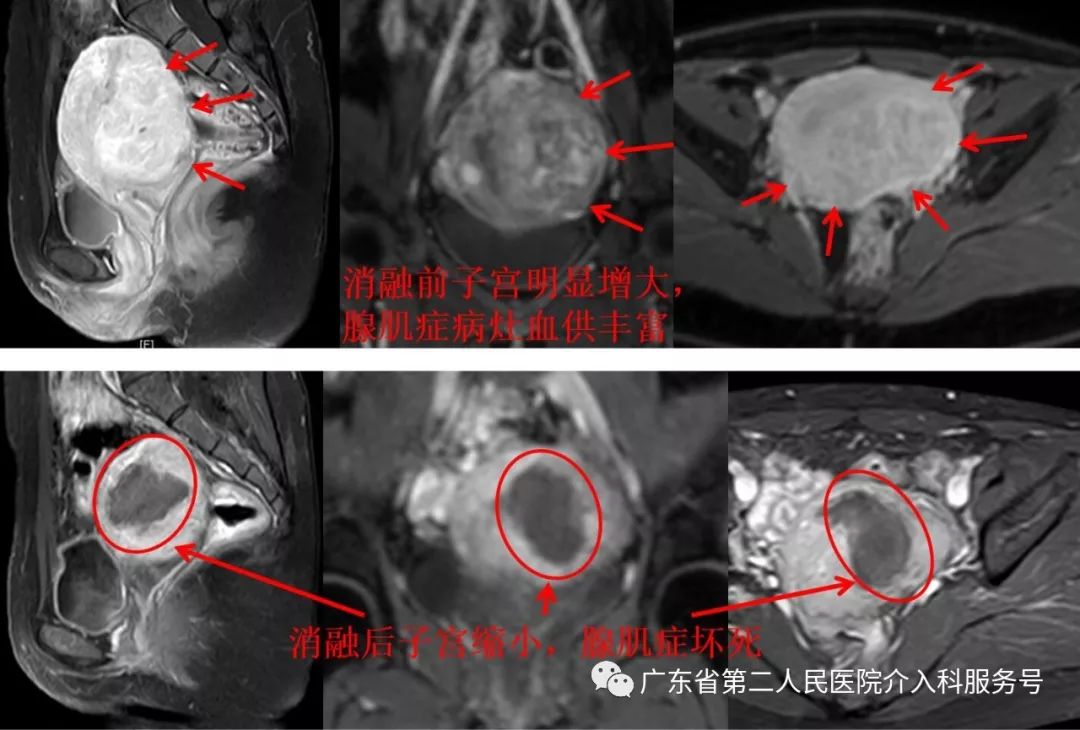 经皮穿刺肿瘤物理消融术,介入治疗痛经