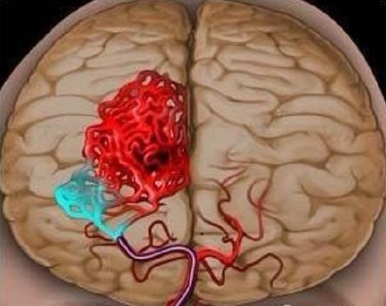 大拇指手发麻是什么病的前兆,骑车手发麻是什么病的前兆