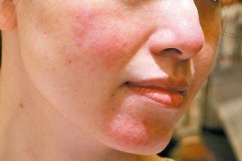 贴面膜有点小刺痛是缺水吗,脸部缺水贴面膜会刺痛是怎么回事