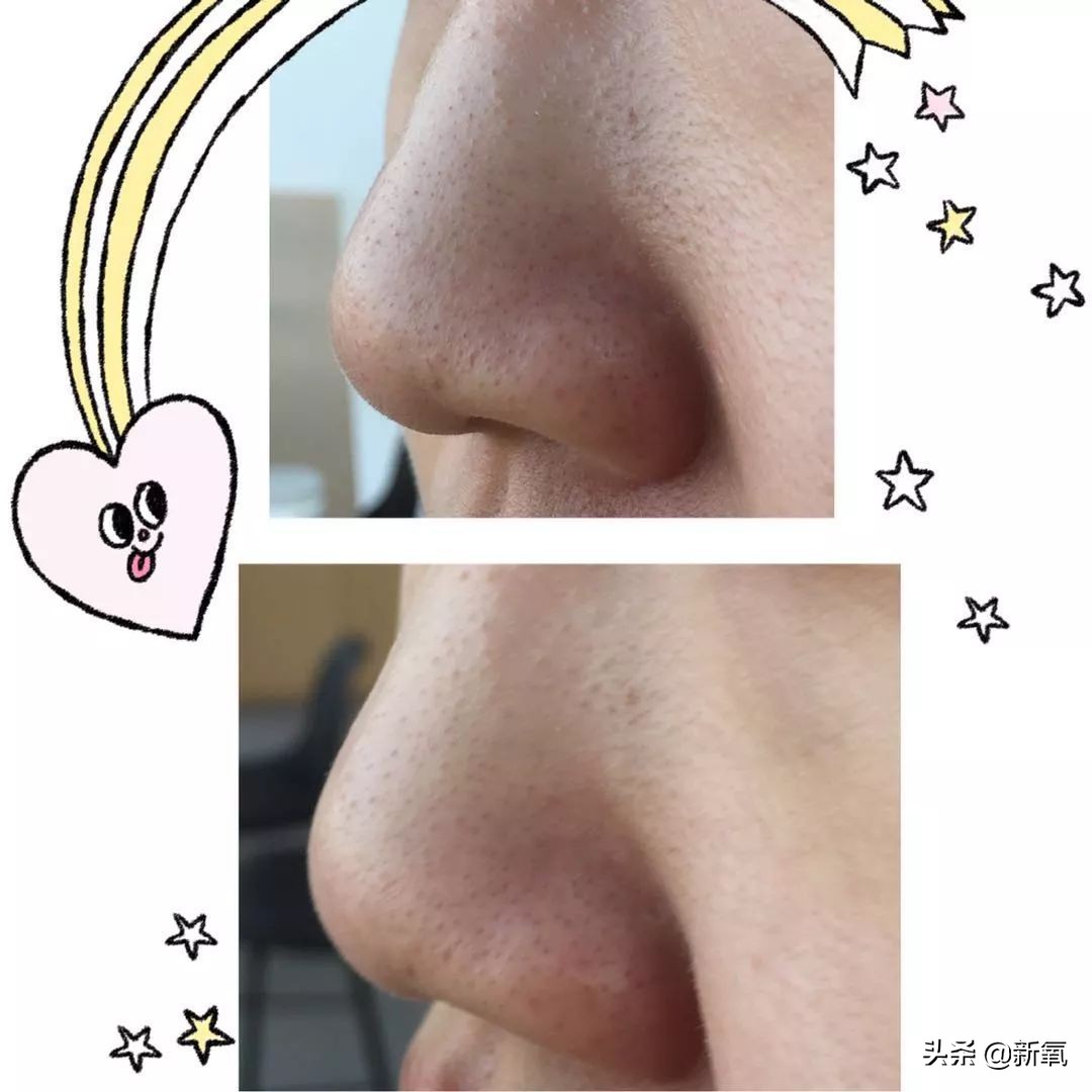 五分钟教你有效去黑头,最火去黑头收缩毛孔