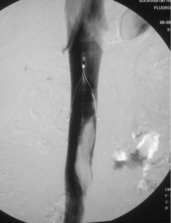 做好五件事远离血栓,做好这6点让你远离血栓的困扰