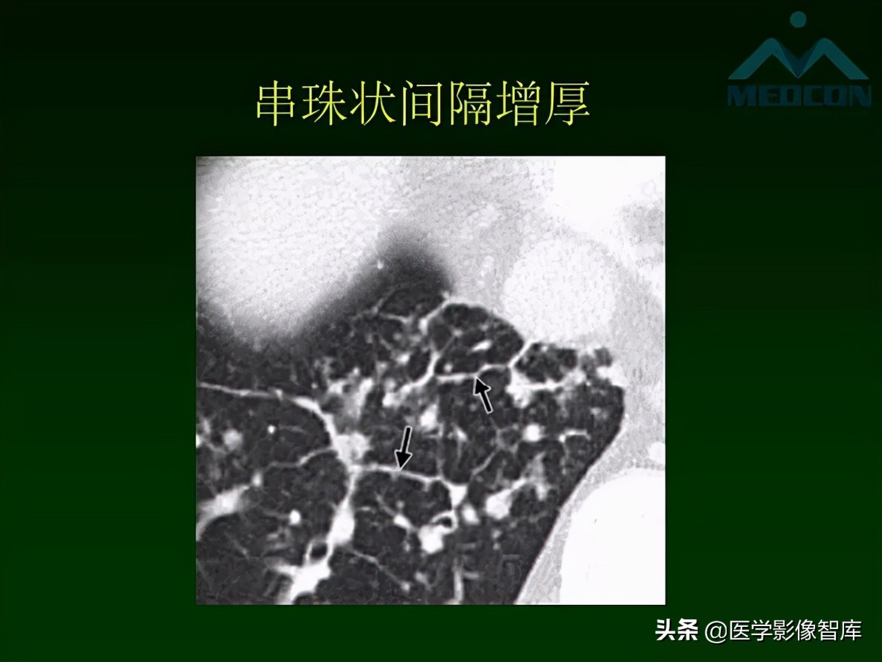 肺弥漫性网状影,两肺小叶间隔增厚可见网状模糊影