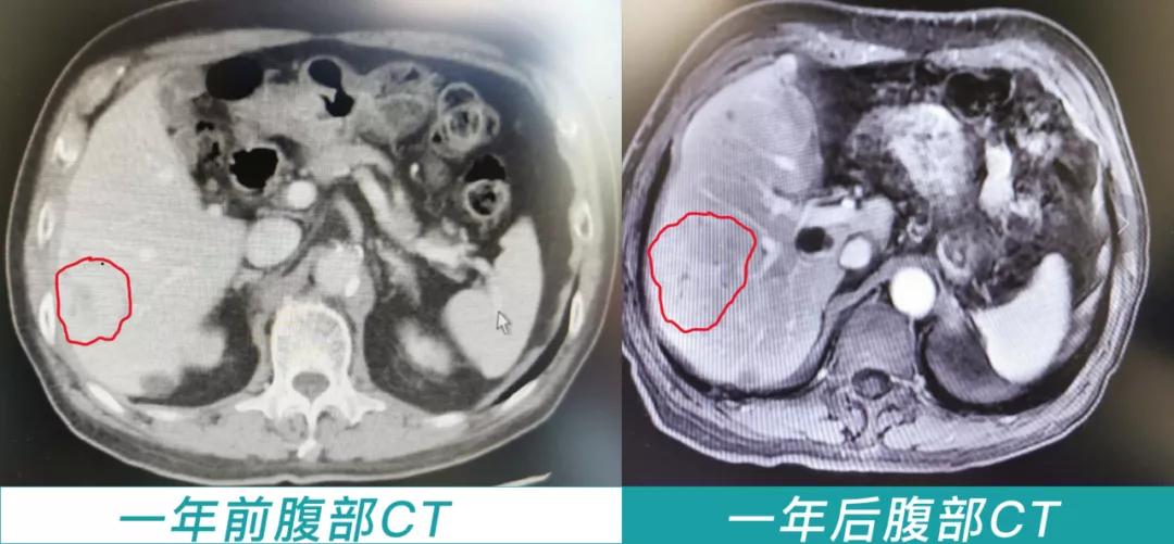 肝癌科普,科普解读肝癌介入