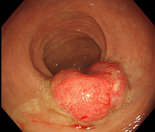 胃肠息肉是癌吗,长了结肠息肉会有什么症状