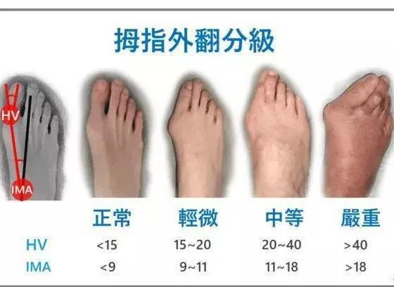 太原中心医院汾东院区骨科,太原汾东中心医院骨科拇外翻大夫