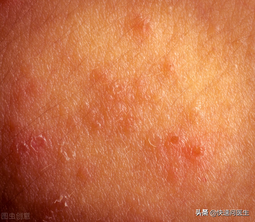 肛门周围潮湿又瘙痒怎么办,肛门周围潮湿瘙痒怎么治疗