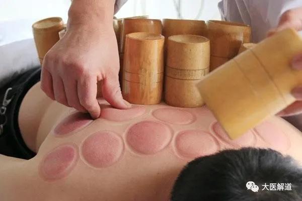 拔火罐利用了什么知识,拔火罐的技巧和手法视频