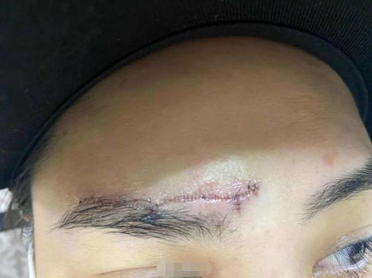 阿娇头部受伤缠绷带照曝光,阿娇受伤后拆绷带首露面