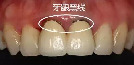 烤瓷牙崩瓷露出里面金属有毒吗,钛合金烤瓷牙有毒吗